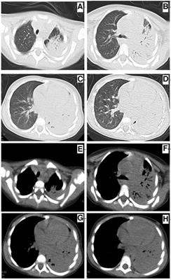 An unusual presentation of necrotizing pneumonia caused by foreign body retention in a 20-month-old child: A case report and literature review